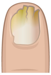 mysosis